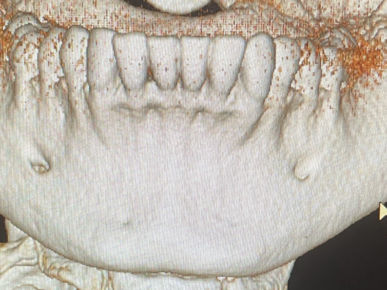 dentalscan ricostruzione dentatura