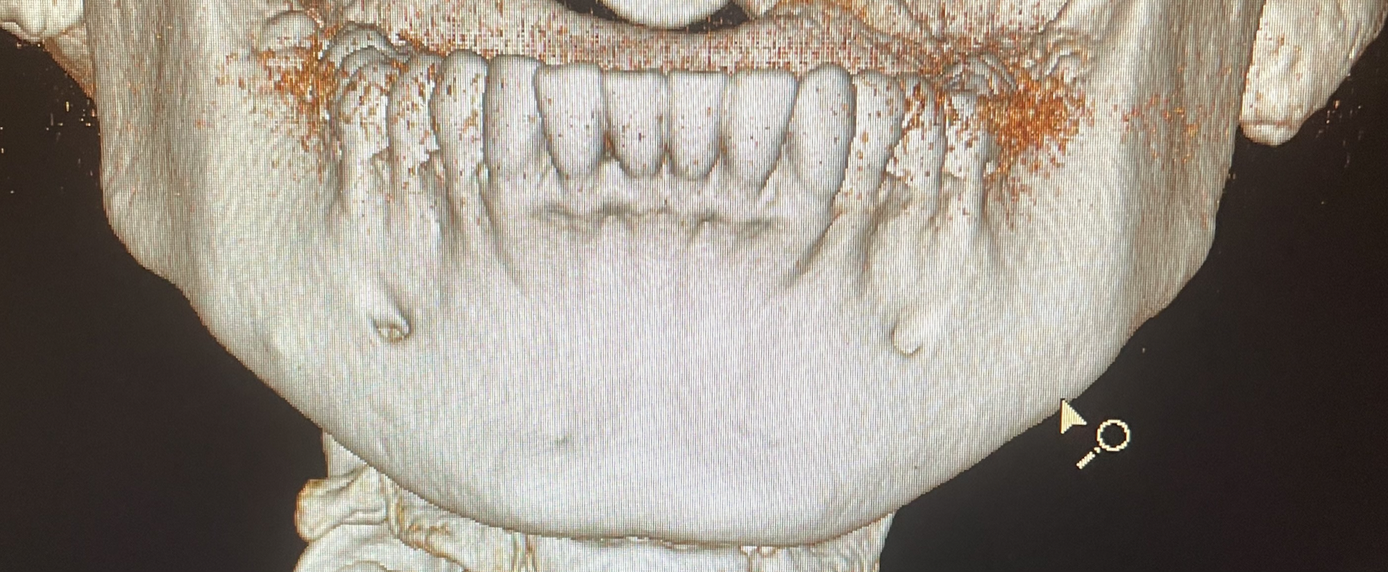 dentalscan ricostruzione dentatura